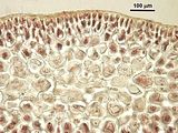 4 - Ispessimenti lenticolari nelle cellule midollari